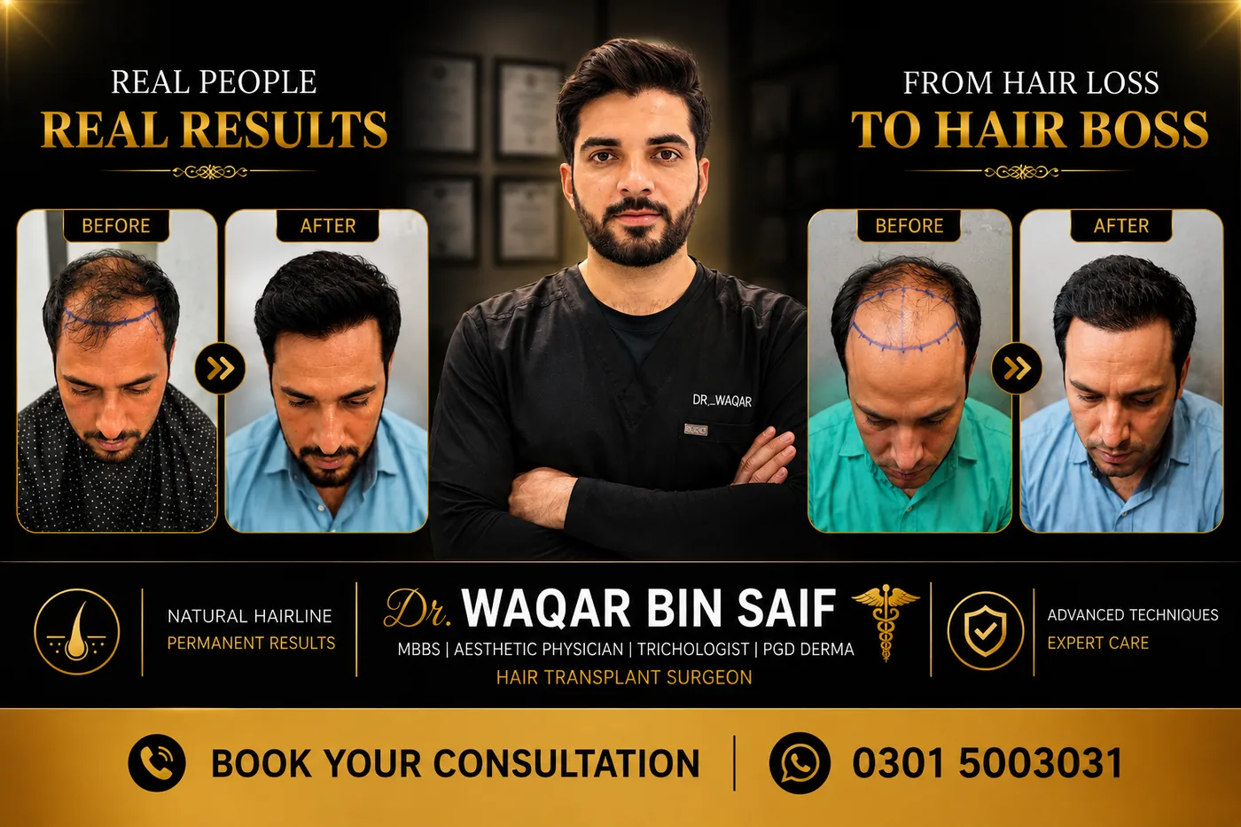 Real people, real results — before and after hair transplant by Dr. Waqar Bin Saif