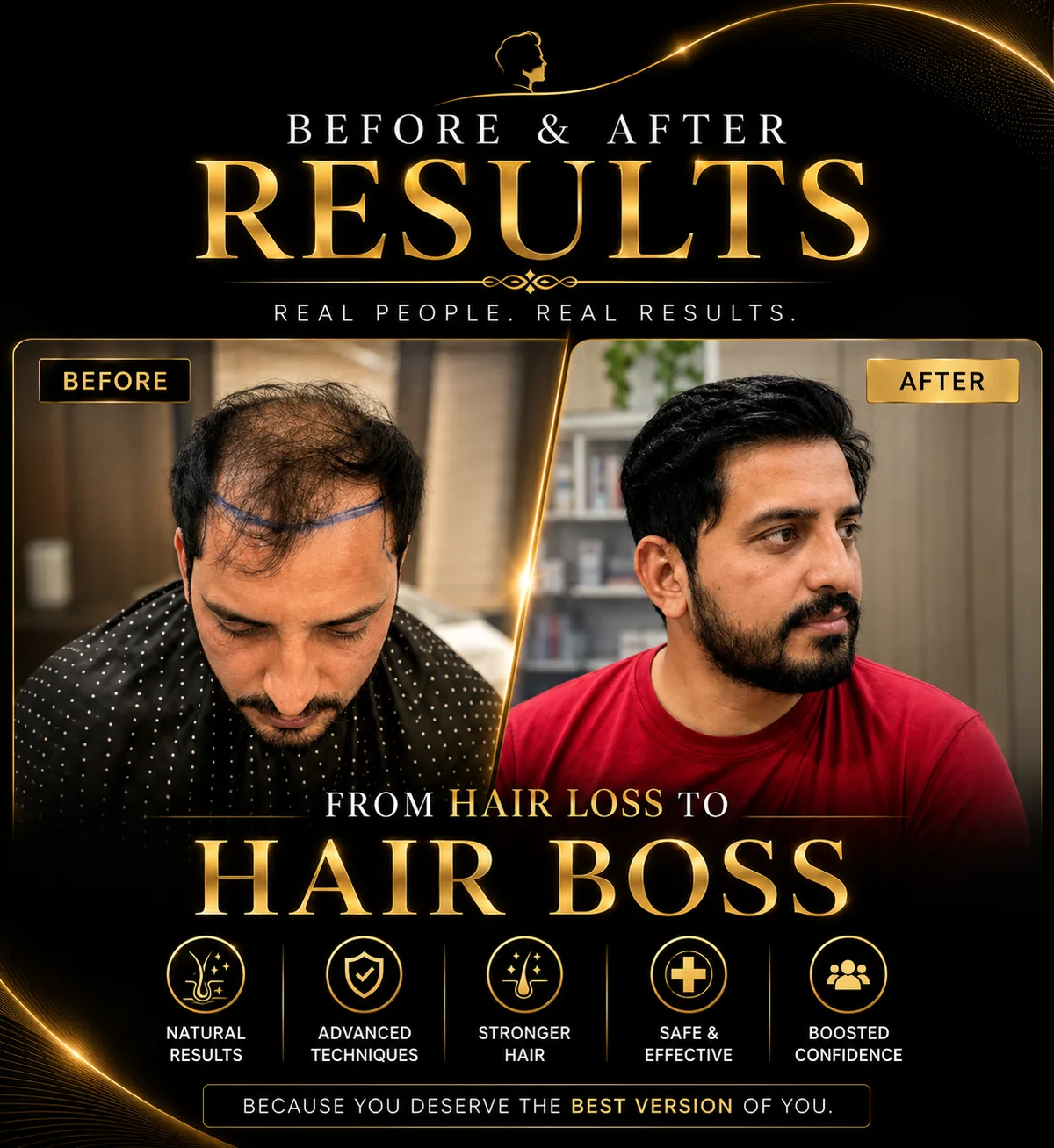 Before and after hair transplant result at WBSK