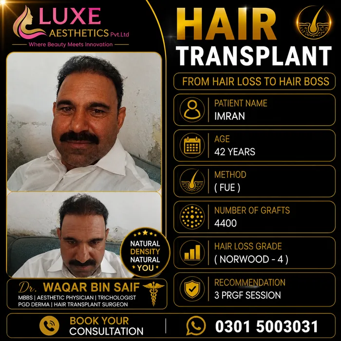 Hair transplant before and after result &mdash; Imran at WBSK