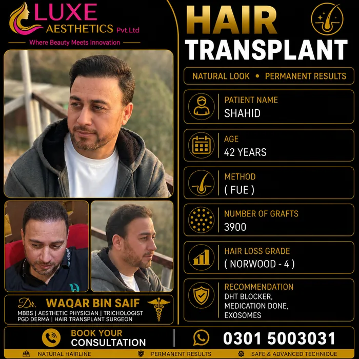 Hair transplant before and after result &mdash; Shahid at WBSK