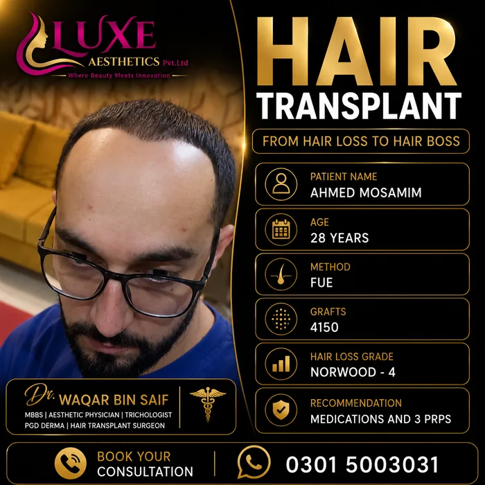 Hair transplant before and after result &mdash; Ahmed Mosamim at WBSK
