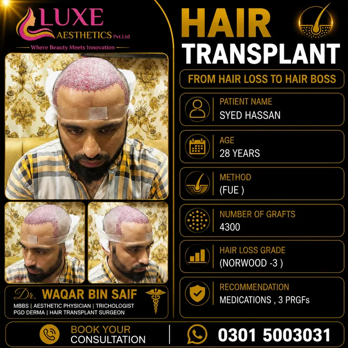 Hair transplant before and after result &mdash; Syed Hassan at WBSK