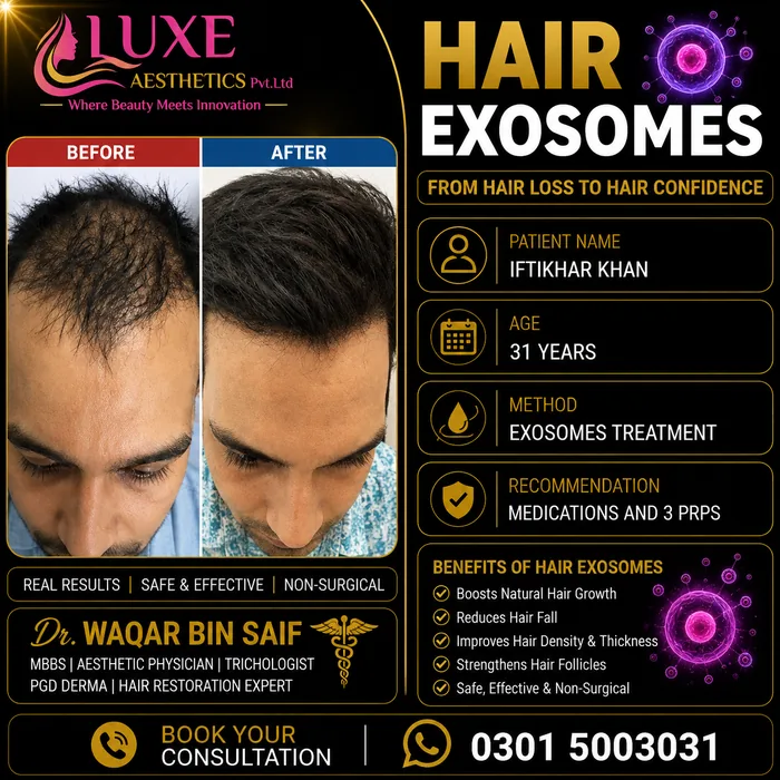 Hair transplant before and after result &mdash; Iftikhar Khan at WBSK