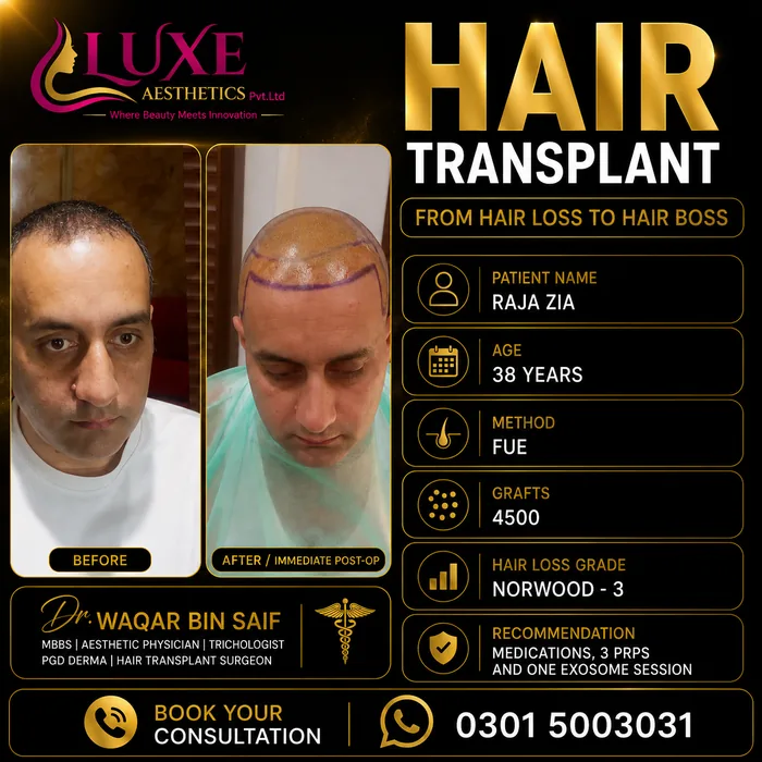 Hair transplant before and after result &mdash; Raja Zia at WBSK
