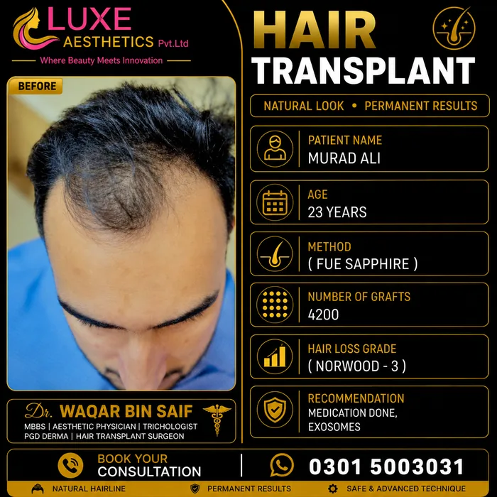 Hair transplant before and after result &mdash; Murad Ali at WBSK