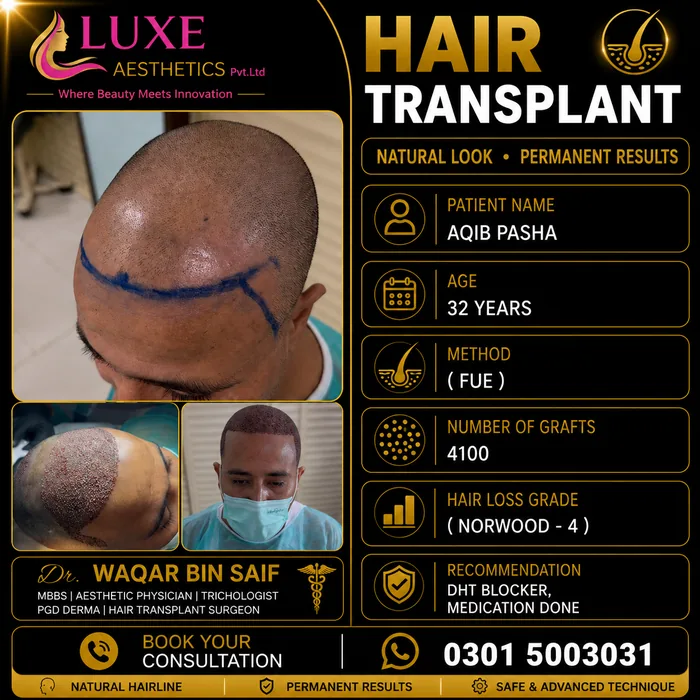 Hair transplant before and after result &mdash; Aqib Pasha at WBSK