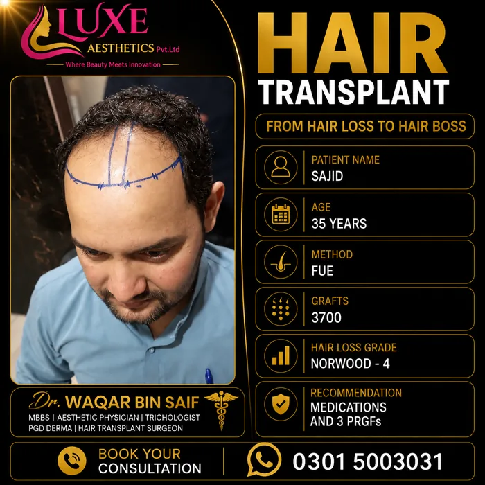 Hair transplant before and after result &mdash; Sajid at WBSK