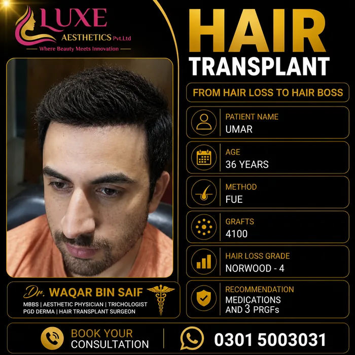 Hair transplant before and after result &mdash; Umar at WBSK