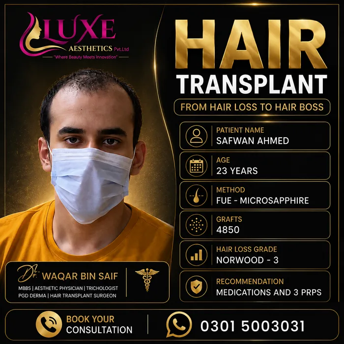 Hair transplant before and after result &mdash; Safwan Ahmed at WBSK
