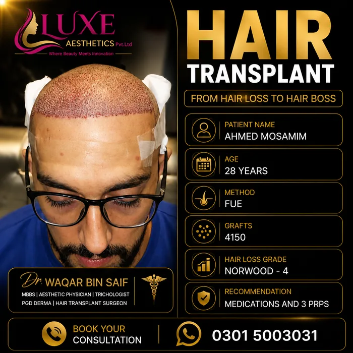 Hair transplant before and after result &mdash; Ahmed Mosamim at WBSK