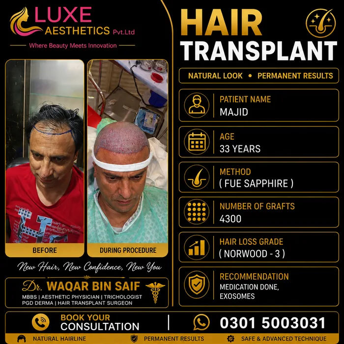 Hair transplant before and after result &mdash; Majid at WBSK