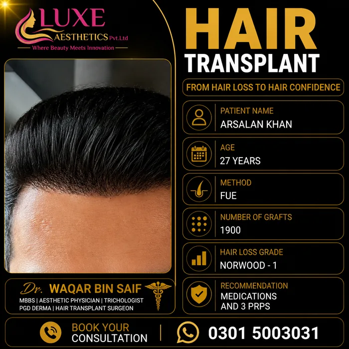 Hair transplant before and after result &mdash; Arsalan Khan at WBSK