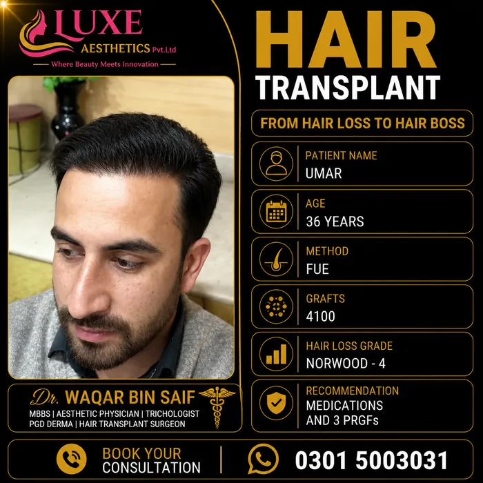 Hair transplant before and after result &mdash; Umar at WBSK
