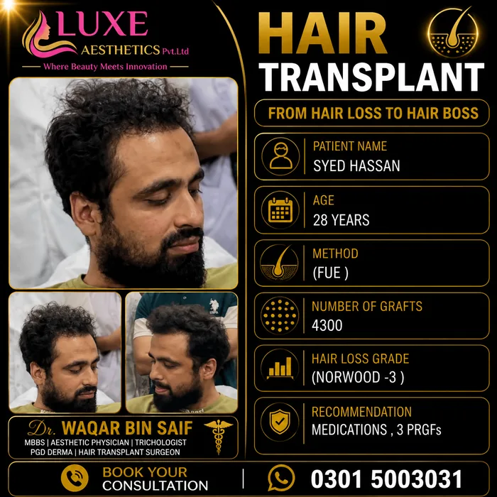 Hair transplant before and after result &mdash; Syed Hassan at WBSK