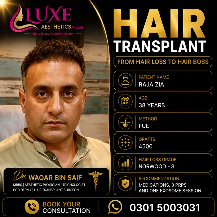Hair transplant before and after result &mdash; Raja Zia at WBSK