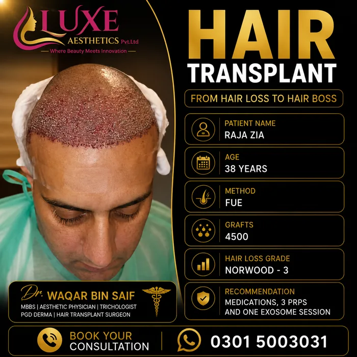 Hair transplant before and after result &mdash; Raja Zia at WBSK