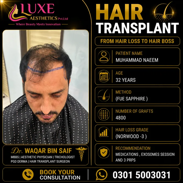 Hair transplant before and after result &mdash; Muhammad Naeem at WBSK