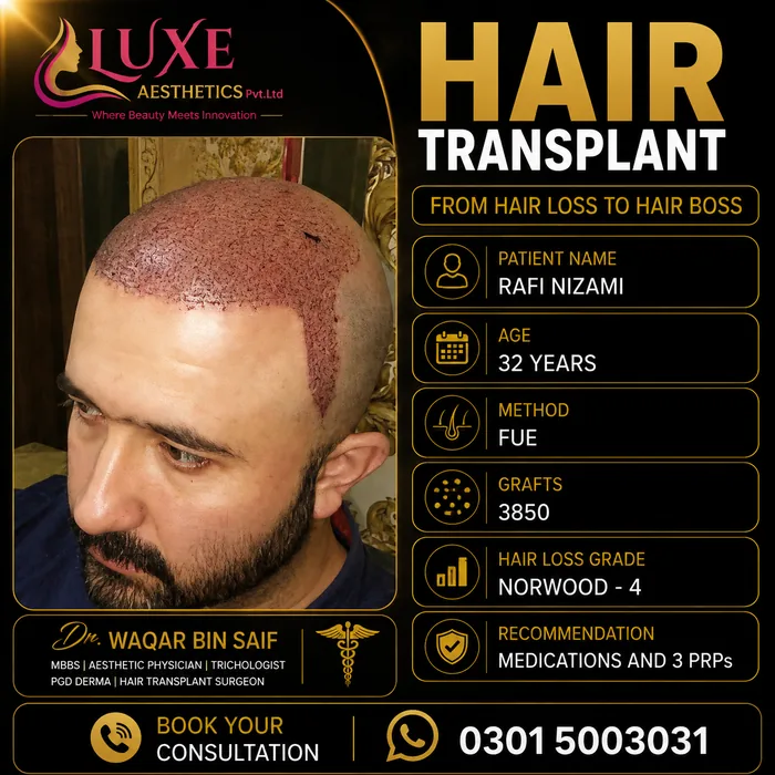 Hair transplant before and after result &mdash; Rafi Nizami at WBSK