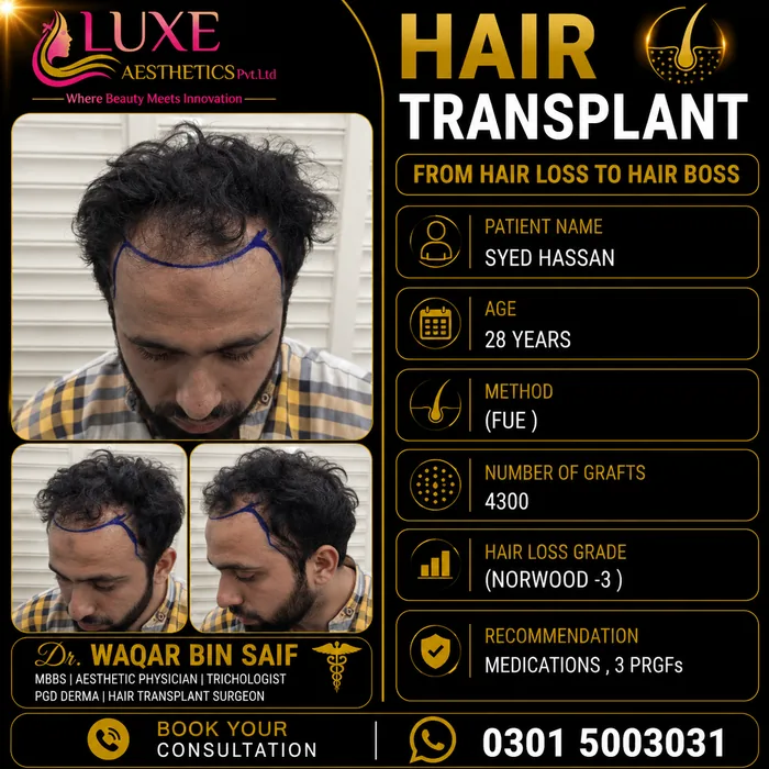 Hair transplant before and after result &mdash; Syed Hassan at WBSK