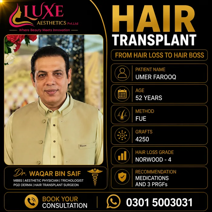 Hair transplant before and after result &mdash; Umer Farooq at WBSK