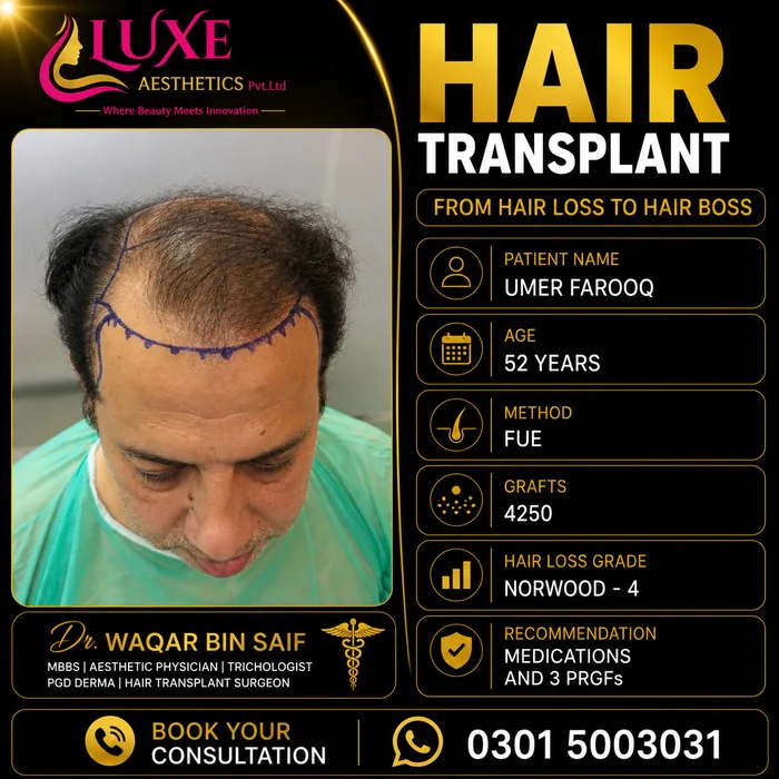 Hair transplant before and after result &mdash; Umer Farooq at WBSK