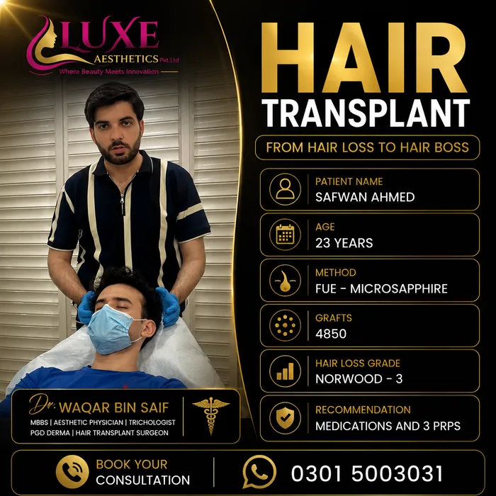 Hair transplant before and after result &mdash; Safwan Ahmed at WBSK