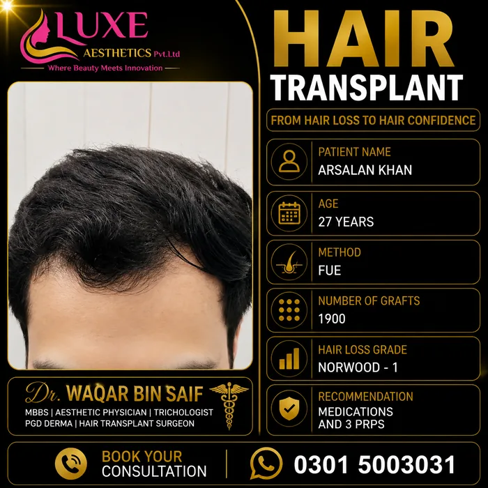 Hair transplant before and after result &mdash; Arsalan Khan at WBSK