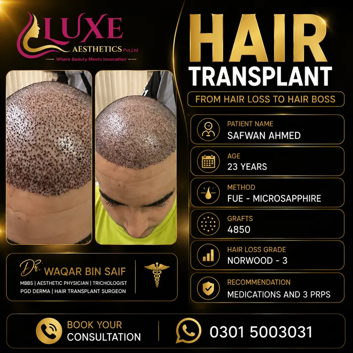 Hair transplant before and after result &mdash; Safwan Ahmed at WBSK