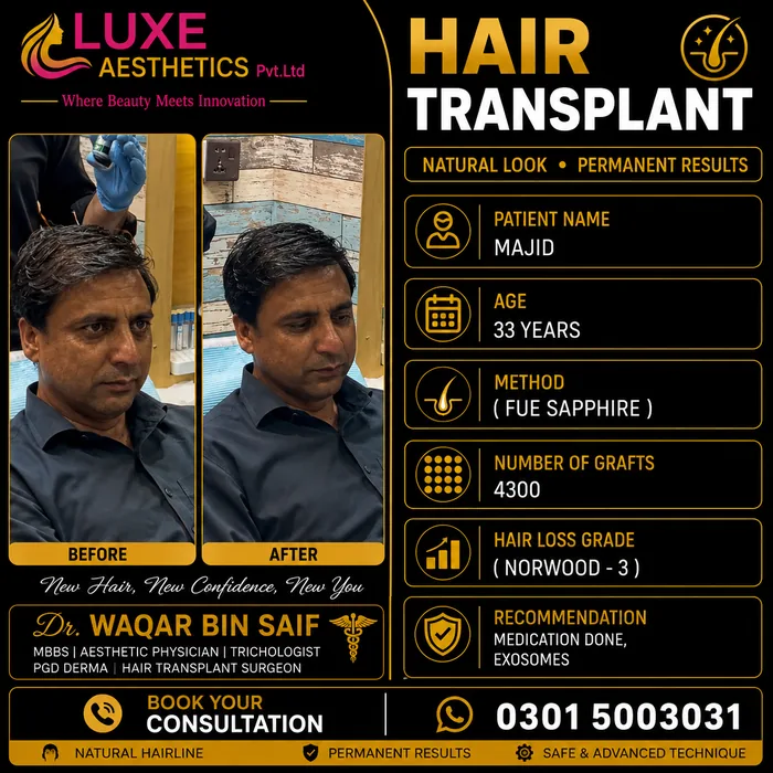 Hair transplant before and after result &mdash; Majid at WBSK