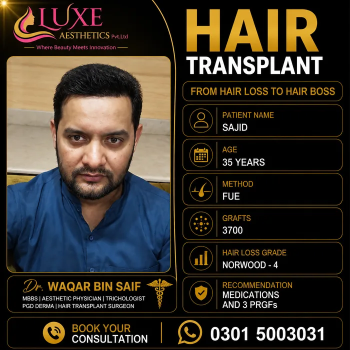 Hair transplant before and after result &mdash; Sajid at WBSK