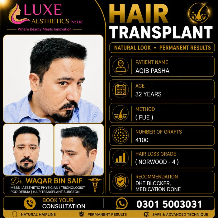 Hair transplant before and after result &mdash; Aqib Pasha at WBSK