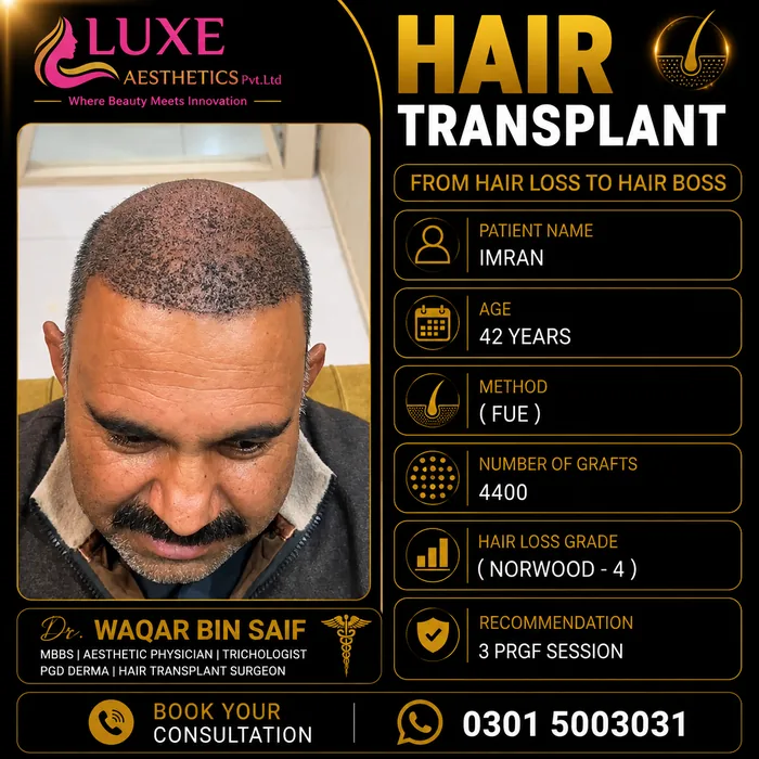 Hair transplant before and after result &mdash; Imran at WBSK