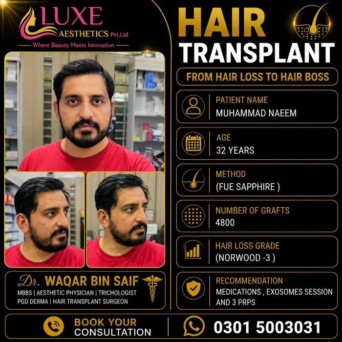 Hair transplant before and after result &mdash; Muhammad Naeem at WBSK