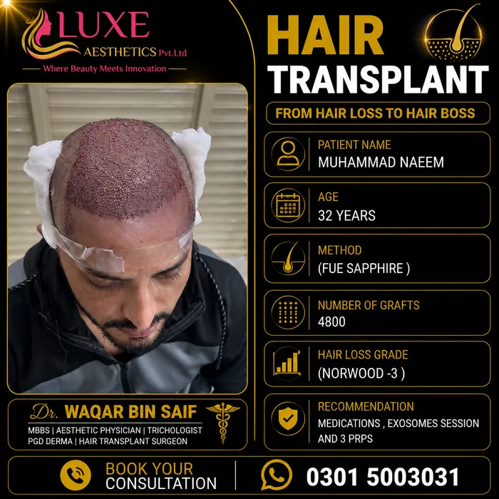 Hair transplant before and after result &mdash; Muhammad Naeem at WBSK