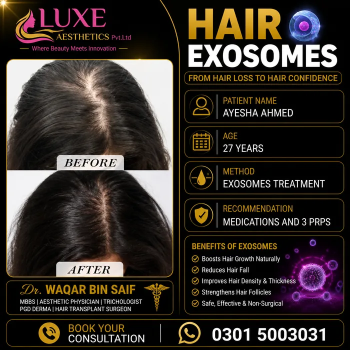 Hair transplant before and after result &mdash; Ayesha Ahmed at WBSK