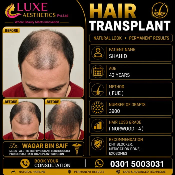 Hair transplant before and after result &mdash; Shahid at WBSK