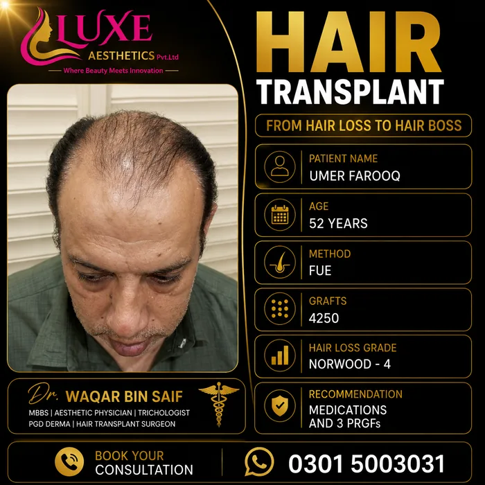 Hair transplant before and after result &mdash; Umer Farooq at WBSK