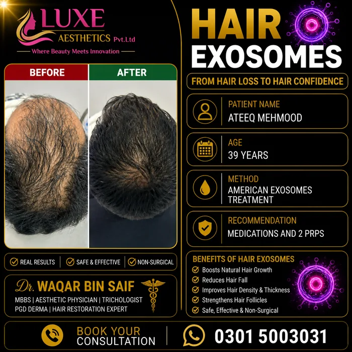 Hair transplant before and after result &mdash; Ateeq Mehmood at WBSK