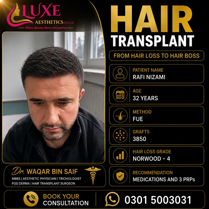 Hair transplant before and after result &mdash; Rafi Nizami at WBSK