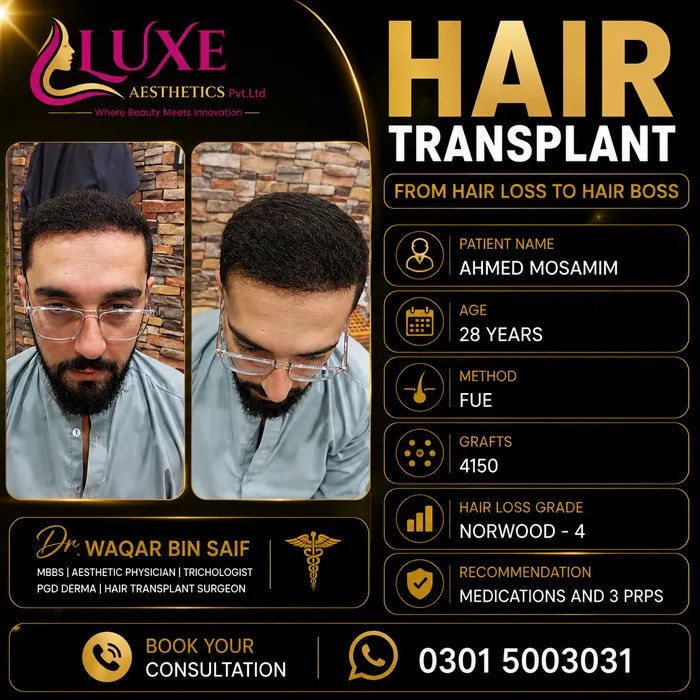 Hair transplant before and after result &mdash; Ahmed Mosamim at WBSK